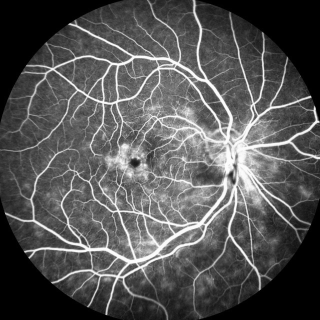 Fluorescein Angiography