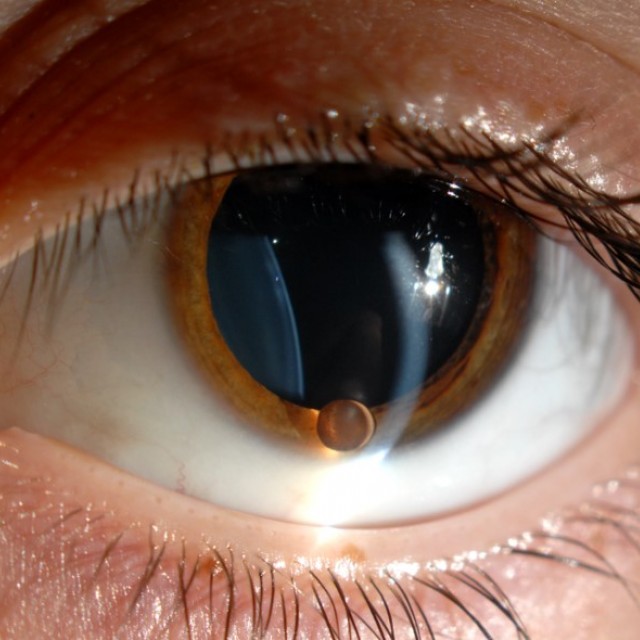 iris Cyst original HP