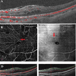 OCTA B-scan image of the left eye of a patient referred for vitrectomy for epiretinal membrane (ERM). OCT shows nasal ERM with inner and outer retinal cystic changes.